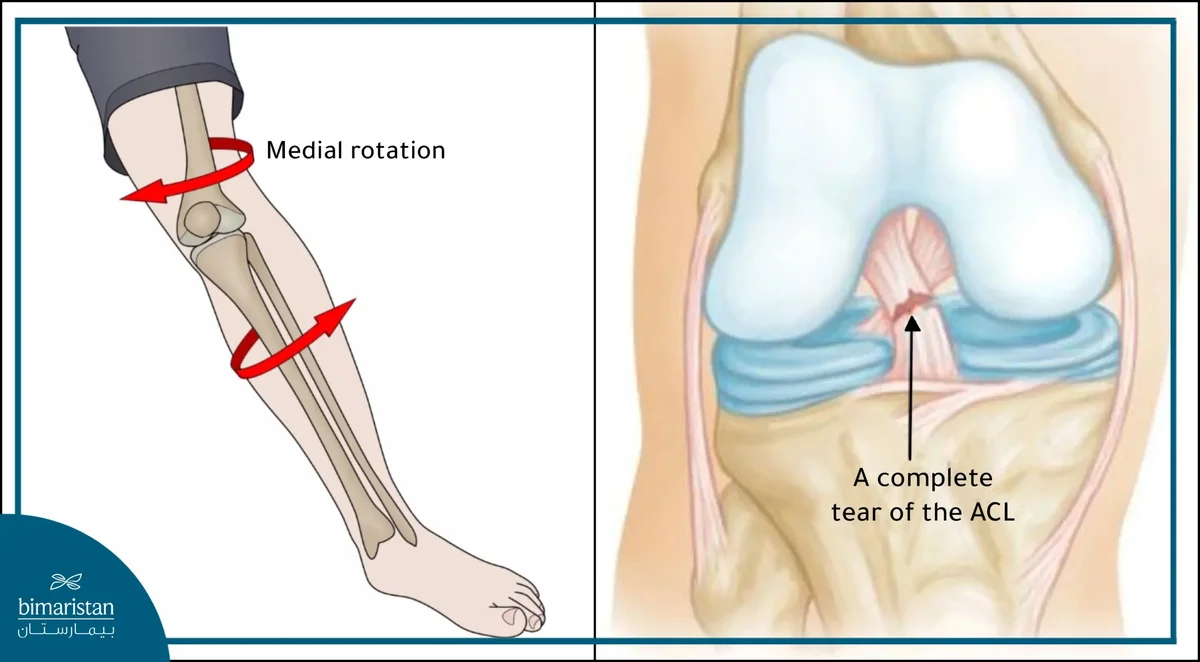 Soft Tissue vs MCL Knee Injury: 10 Treatment Facts